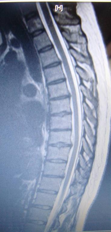 thoracic disc herniation treated by San Jose chiropractor